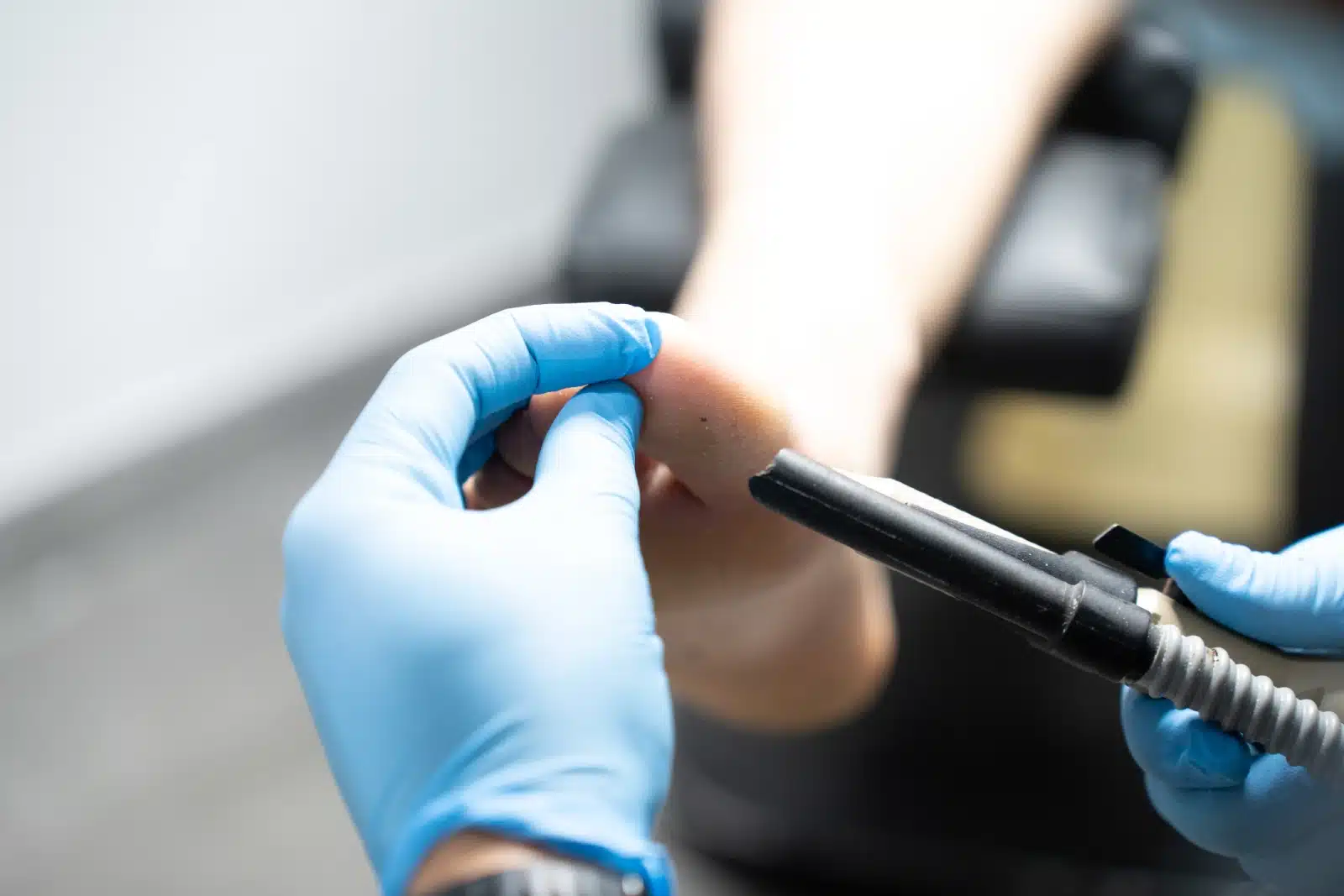 podologo pasando maquina a un paciente